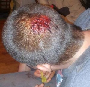 Zach Armstrong of Perry was treated for a head injury at the Dallas County Hospital after striking a vehicle while riding his bicycle. He was released from the hospital after six staples were used to close a wound on the crown of his head. Photo courtesy Dyan Chinberg
