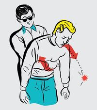 The Heimlich maneuver is a method of forcibly expelling matter from the trachea of a choking person.